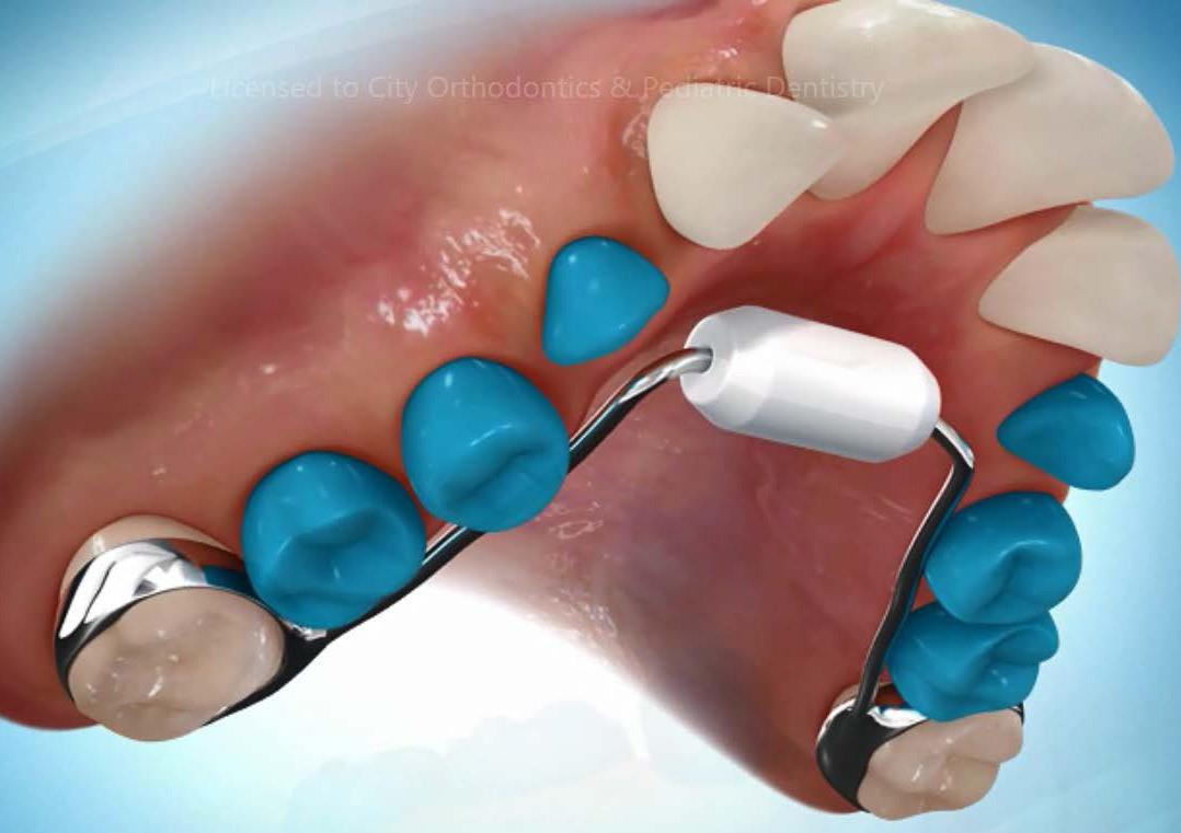 What Is A Thumb Sucking Appliance what-is-a-thumb-sucking-appliance